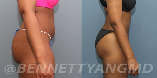 Brazilian Butt Lift – BBL Before & After Pictures.