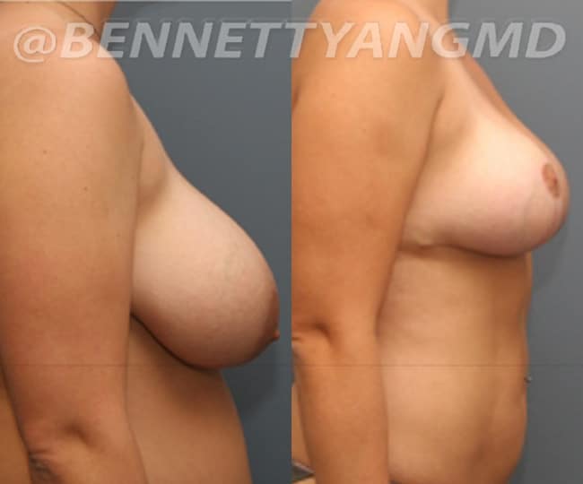 Breast Reduction Patient Before & After Images - Maryland Breast Surgeon Breast Lift Patient Before & After Images - Maryland Breast Surgeon