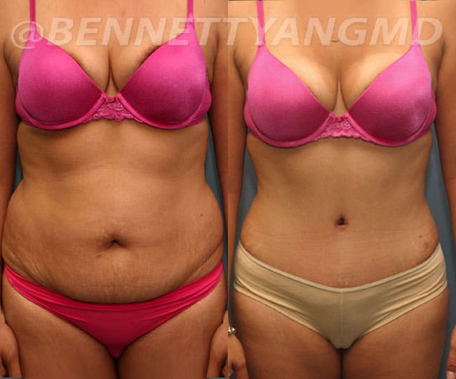 Hourglass Plastic Surgery - Snatched